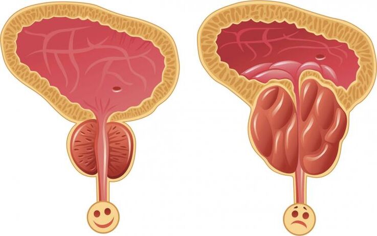 Prostate saine et prostatite