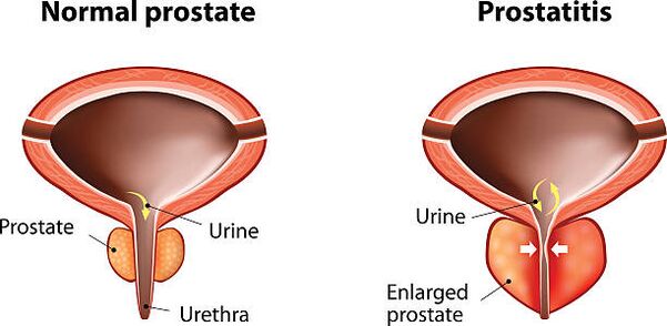 prostate normale et enflammée
